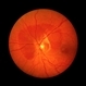 Choroidal Rupture with Subretinal Hemorrhage Choroidal Rupture with Subretinal Hemorrhage